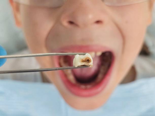 Best Dental Abscess Treatment in East Hazel Crest, IL